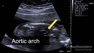 Pregnancy scan report analysis PartI  Early Antenatal scan [upl. by Araldo]