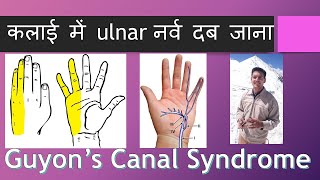 कलाई में ulnar नर्व दब जाना Guyons Canal Syndrome Hindi [upl. by Nyrual]