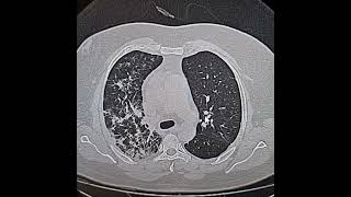 Interstitial pattern 18 of Pneumocystis Jirovici pneumonia and its response to CoTrimoxazole [upl. by Lonni]