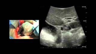 BK Medical Intraoperative Ultrasound Imaging of the Liver [upl. by Zacharia]