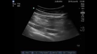 piriformis injection [upl. by Tem]