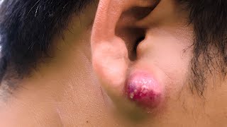 Ear Abscess [upl. by Icart]