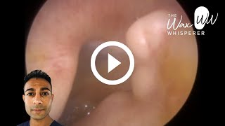 995  Exostosis aka ‘Surfer’s Ear’ Ear Wax Removal [upl. by Tarrant]