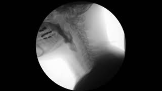 Modified Barium Swallow MBS or VFSS [upl. by Alywt402]