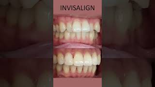 Invisalign  Before And After  Crooked Teeth  London UK [upl. by Ensoll149]