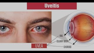 what the uveitis is [upl. by Eelnayr]