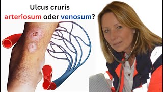 Was ist der Unterschied zwischen einem ulcus cruris arteriosum und venosum [upl. by Singh570]