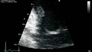 RUPTURE CHORDAE POSTEROMEDIAL PAPILARY MUSCLE  MR PROLAPSE [upl. by Ona948]