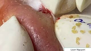 Blackheads extraction with Loan Nguyen Spa n10 [upl. by Rentschler]