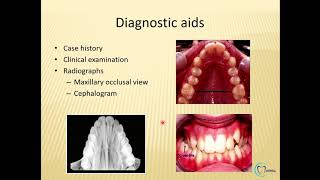 Arch expansion in orthodontics part 1 made easy  Orthodontics  Dentophile [upl. by Eerrehs9]