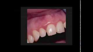 Precise LTM Periodontal Curretage Clinical Procedure [upl. by Yecad]