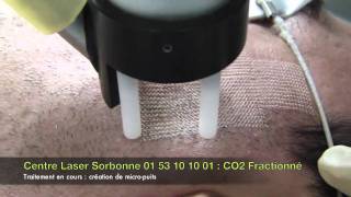 Vidéo Cicatrice dacné CO2 fractionné LaserSorbonne [upl. by Stead105]