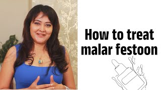 Best ways to treat Malar Festoon  Dr Shuba Dharamana  Dermatologist  Lejeune Medspa [upl. by Yramliw]