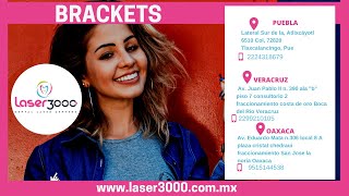 COLOCATE BRACKETS EN PUEBLA VERACRUZ OAXACA CON NOSOTROS [upl. by Anirbas854]