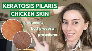 Keratosis Pilaris How to treat dry bumpy skin aka chicken skin  Dr Shereene Idriss [upl. by Caresa]