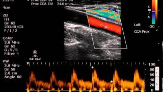 Nearocclusion of the CCA  Case Study [upl. by Agnes]