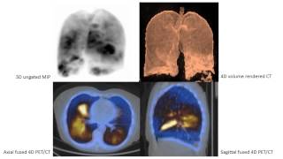 Respiratory gated 4D Lung Perfusion PETCT Imaging [upl. by Werdna]