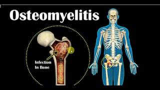 ORTHOPEDICS LECTURES  OSTEOMYELITIS Part 1 [upl. by Simmie607]