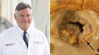 Surgeon QampA Mitral Annular Calcification What Should Patients Know [upl. by Niven993]