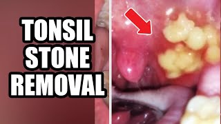 Tonsils Stone Removal Causes amp Treatment 2021 [upl. by Nywra]