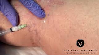 More Sclerotherapy Treatment for Spider Veins [upl. by Acinimod]