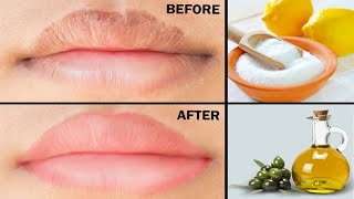 Simple Home Remedies for Dry Cracked LIPS  Tips for chapped lips  15dayschallenge Day 10 [upl. by Teodoro]