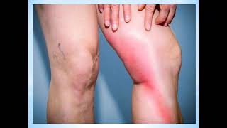 What is Phlebitis and How is it Treated [upl. by Chelsae931]