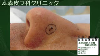 動画による皮膚病の解説 第９回 【基底細胞癌】 [upl. by Potts]