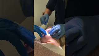 Dermatofibroma lesion removal at The Doctors Laser Clinic Norwich [upl. by Natiha]