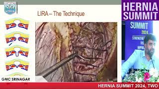 Laparoscopic Intracorporeal Rectus Aponeuroplasty  Dr GM Naikoo Hernia Summit 2024 [upl. by Trager337]