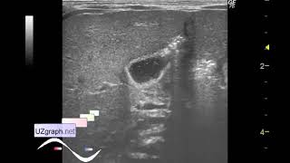 Ecografía abdominal pediátrica  Atresia duodenal [upl. by Eves959]