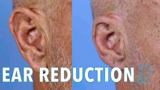 Make Your Large Ears Small in Size with Macrotia Specialist Dr Hilinski [upl. by Htomit]