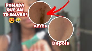 POMADA PARA ESPINHAS ACNE QUE SALVA EM POUCOS DIAS 😍 [upl. by Tompkins]