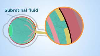 Subretinal fluid a novel approach to macular holes [upl. by Albarran87]