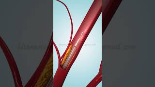 Coronary Angioplasty and Stent Insertion [upl. by Sirovart]