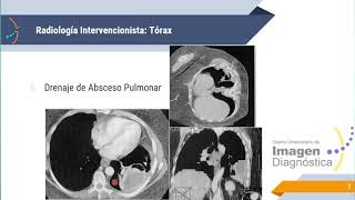 Radiología Intervencionista [upl. by Ezalb778]