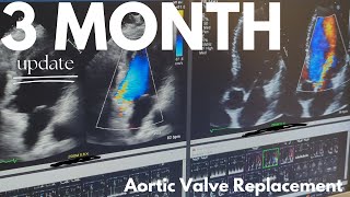 3 Month Update  Post Aortic Valve Replacement Surgery [upl. by Ael488]