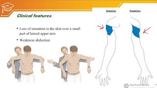 Axillary nerve injury [upl. by Idet]