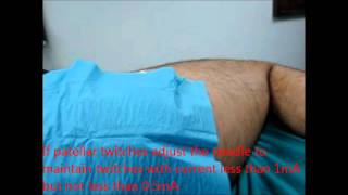 posterior lumbar plexus block nerve stimulationwmv [upl. by Orozco]