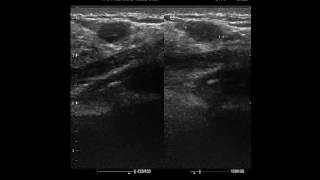 CASE 281 SONOMAMMOGRAPHY FIBROADENOSIS [upl. by Aryamo507]