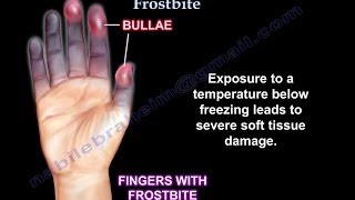 Frostbite UPDATE  Everything You Need To Know  Dr Nabil Ebraheim [upl. by Atnwahs484]