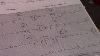 📎 Electrocardiograma en INFARTO AGUDO DE MIOCARDIO 🫀 [upl. by Euqinamod91]