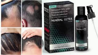 MINOTAL ULTRA Topical Solution Minoxidil 10 with Finasteride 01 Topical Solution [upl. by Winfred]