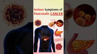 Serious symptoms of pancreatic cancer [upl. by Courtenay]