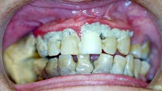 Extreme dentist teeth scale cleaning 2020 [upl. by Ulrich852]