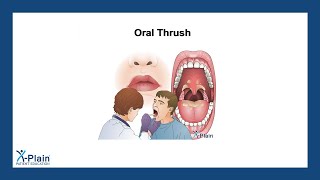 Oral Thrush [upl. by Ahseiym689]