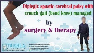 Diplegic spastic cerebral palsy with crouch gait bend knee managed by surgery amp therapy [upl. by Aneele]