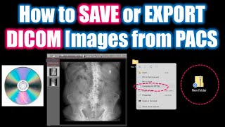 How to save DICOM images from PACS howto radiology dicom [upl. by Kcirredal]