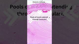 Histology of colitis cystica profunda [upl. by Anilocin]