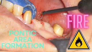 PONTIC AREA DEVELOPMENT with electrocauter [upl. by Aiciles]